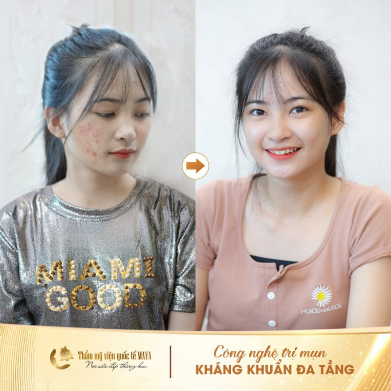 Hình ảnh khách hàng trước và sau trị mụn