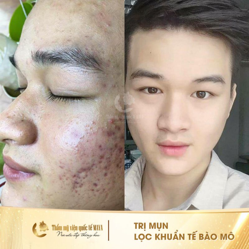 Hình ảnh khách hàng trước và sau trị mụn
