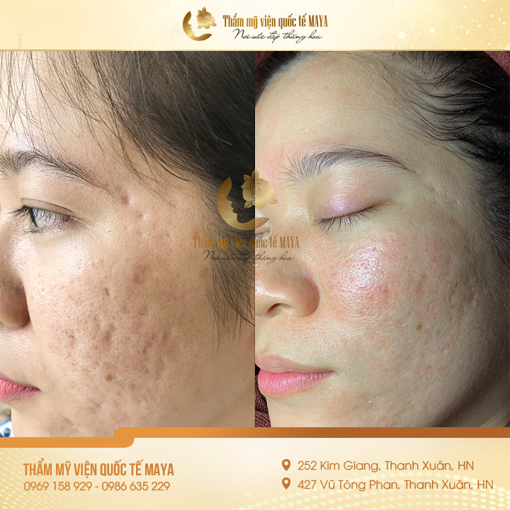 Hình ảnh khách hàng trước và sau trị mụn