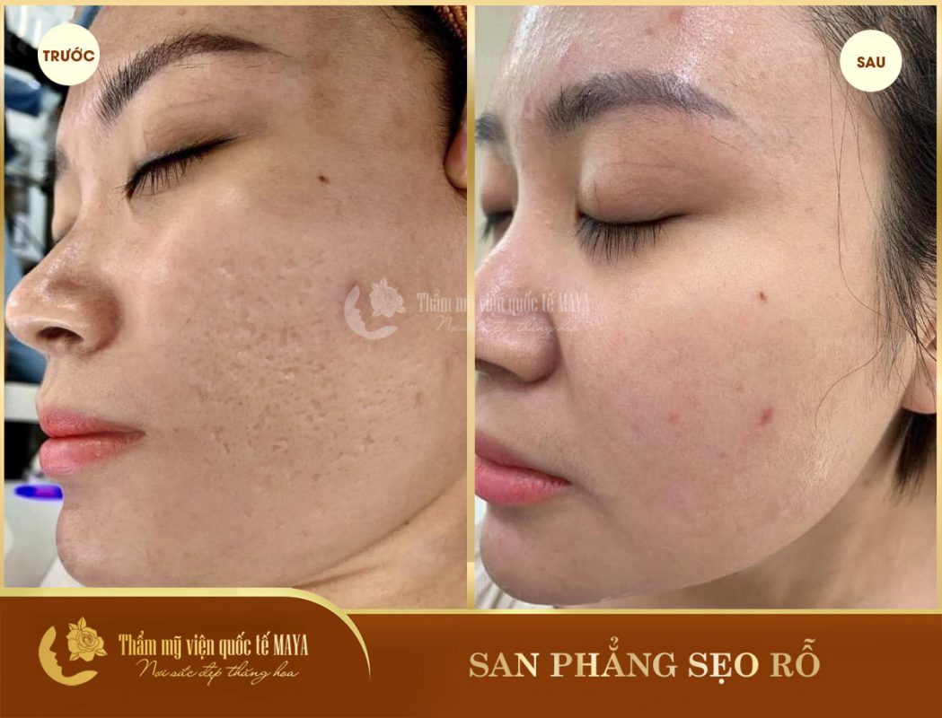 Hình ảnh khách hàng trước và sau trị mụn
