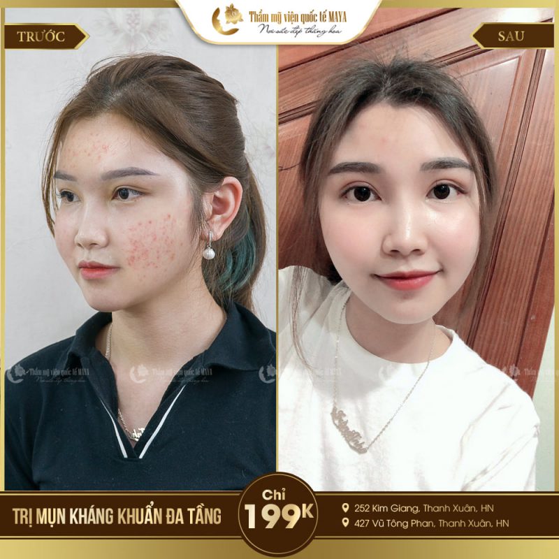 Hình ảnh khách hàng trước và sau trị mụn
