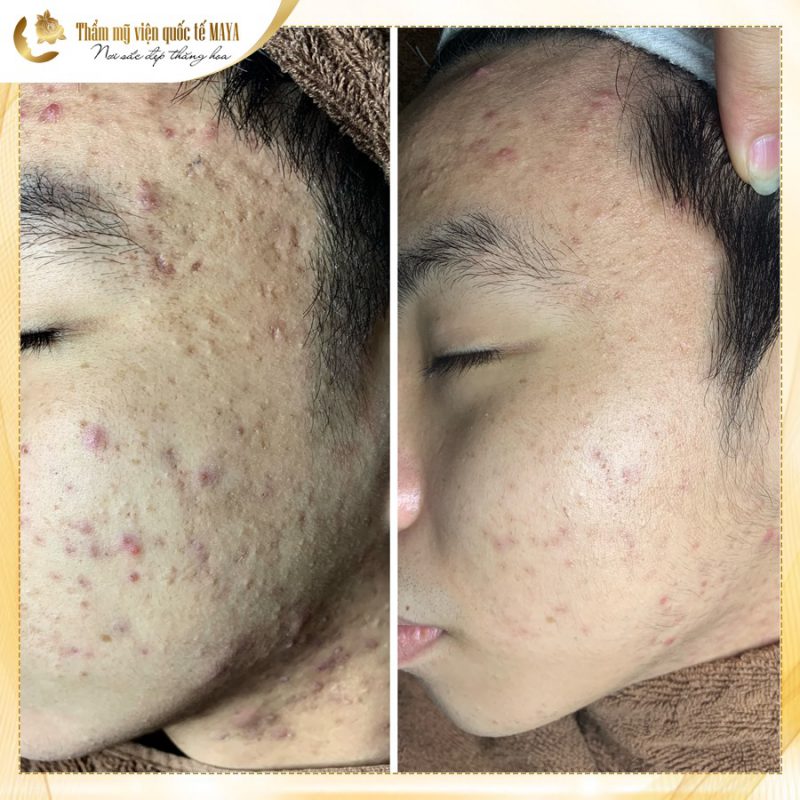 Hình ảnh khách hàng trước và sau trị mụn
