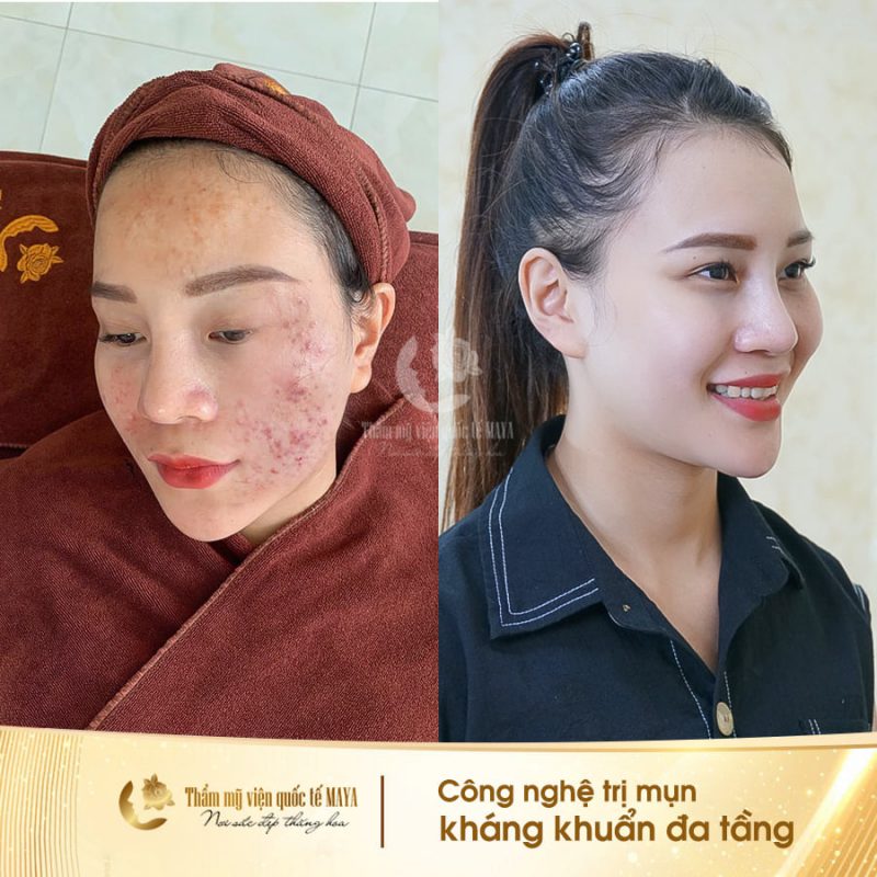 Hình ảnh khách hàng trước và sau trị mụn