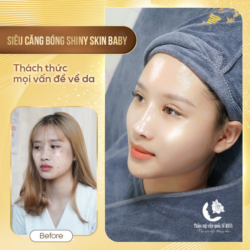 Hình ảnh khách hàng trước và sau trị mụn