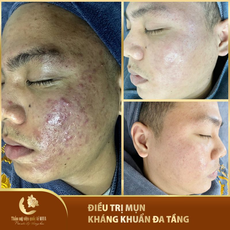 Hình ảnh khách hàng trước và sau trị mụn