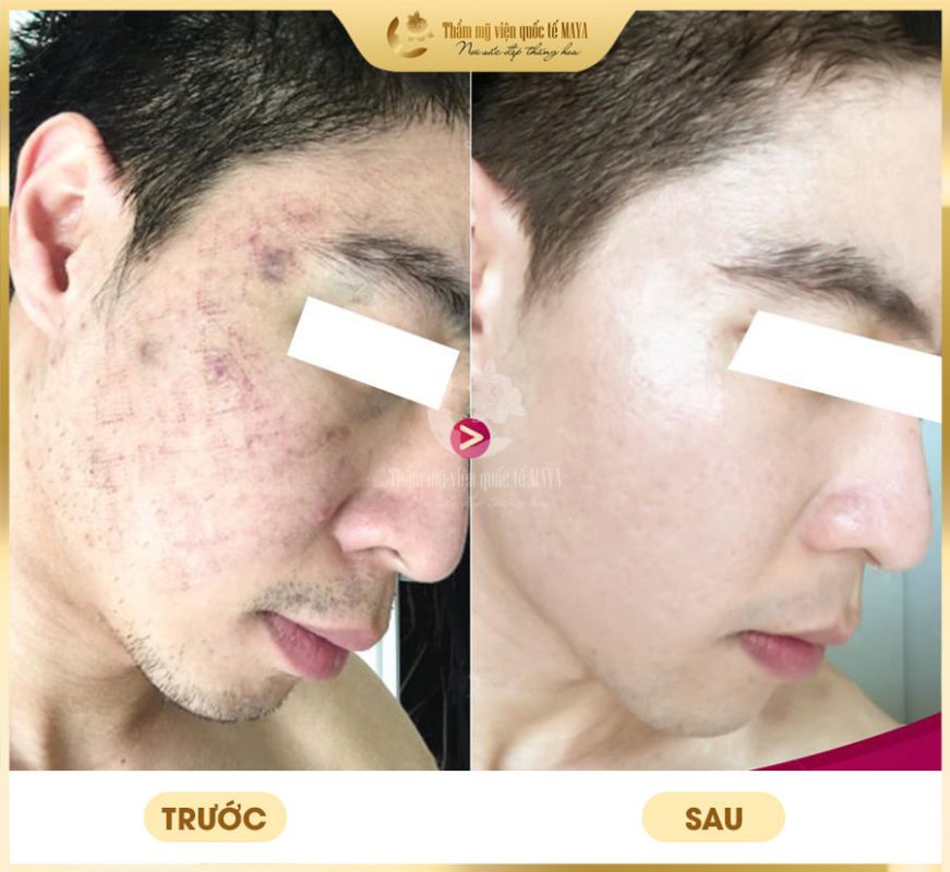 Hình ảnh khách hàng trước và sau trị mụn