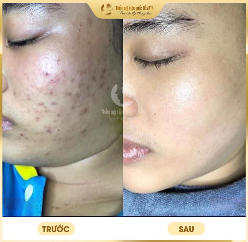 Hình ảnh khách hàng trước và sau trị mụn